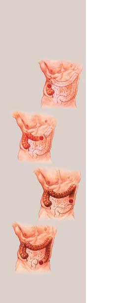 Types of colostomies A colostomy can be made at almost any point along the length of the colon. Where your colostomy will be depends on the medical reason for your surgery.