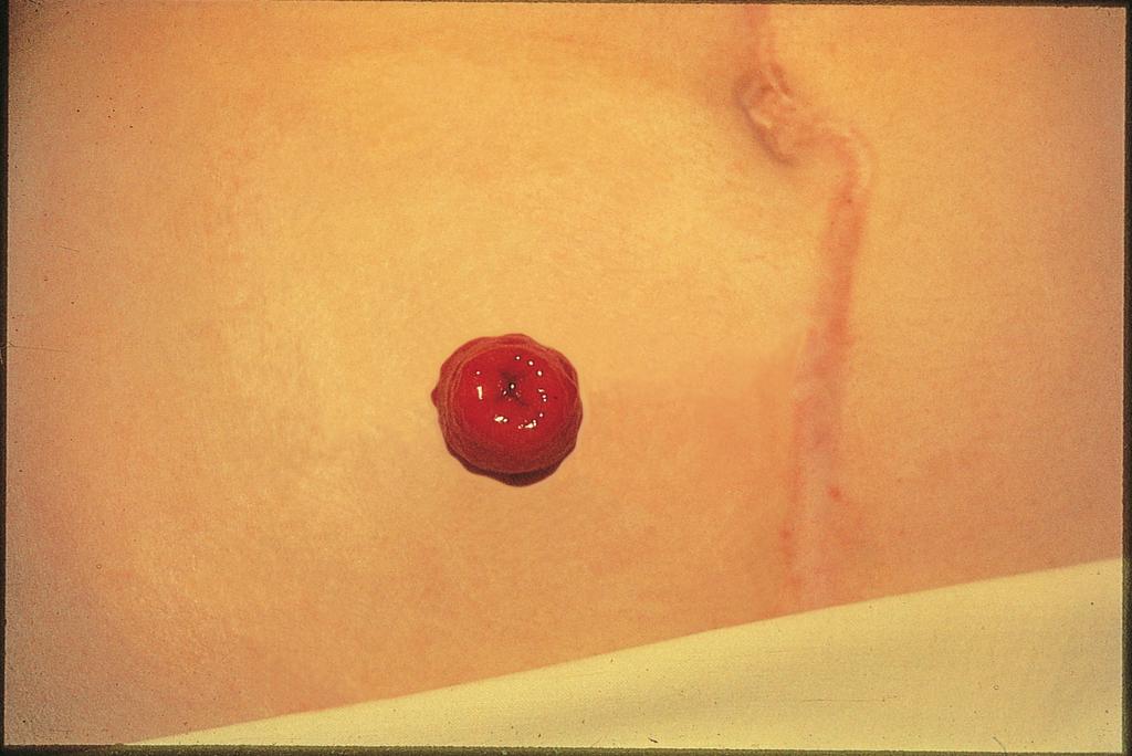 An ileostomy is a surgically created opening into the small intestine through the abdomen. The purpose of an ileostomy is to allow stool to bypass the colon.