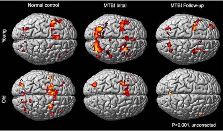 Additional studies using fmri have compared the recovery from MTBI in younger vs. older patients.