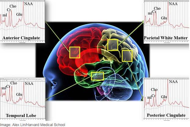 Magnetic Resonance Spectroscopy MRS is being used in research to develop a non-invasive test that can provide a straightforward diagnosis for either PTSD or MTBI, or both.