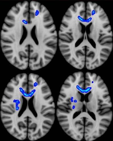 Diffusion Tensor Imaging DTI may play a key role in predicting military veterans functional post-deployment outcomes (i.e. how soon they return to work) following a MTBI during combat.