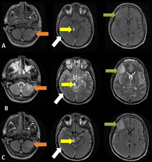 Severe TBI Thirty eight patients were classified as severe TBI, with 33 cases presenting with more than one CT finding.