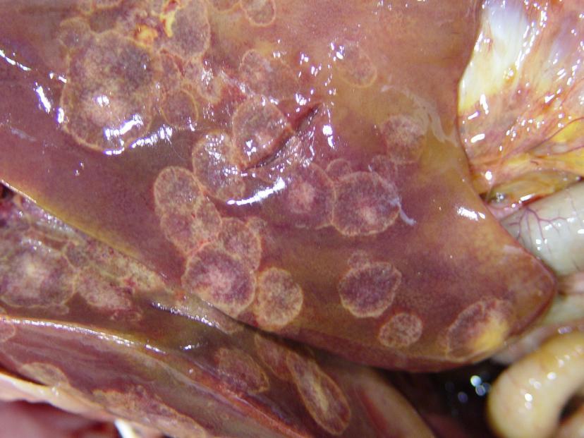 Describe the lesion: Numerous, white, thick-capsuled, firm nodules with dense white exudates ranging from 5mm to 3cm in greatest diameter were scattered throughout the liver.