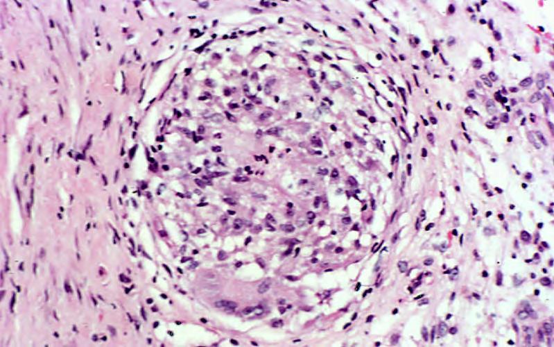 Granulomatous inflammation: Well circumscribed granuloma (outlined in black) with many epithelioid macrophages (some indicated by
