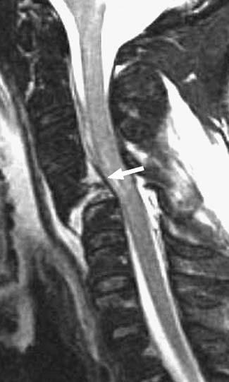 Fig. 1 True-negative intact posterior longitudinal ligament by MRI. 29-year-old male with bilateral interfacetal dislocation at C4-5.