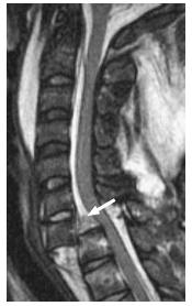 Fig. 2 True-positive tear posterior longitudinal ligament by MRI. 36-year-old male with bilateral interfacetal dislocation at C7-T1.