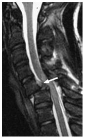 expected location, that was confirmed at surgery. Fig. 3 False-negative intact posterior longitudinal ligament by MRI. 41-year-old male with bilateral interfacetal dislocation at C5-6.