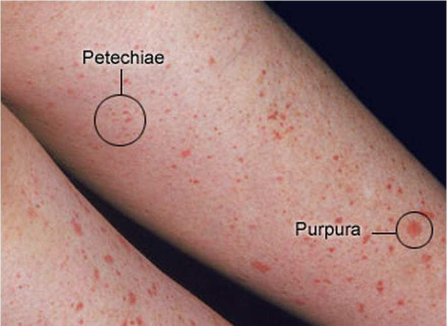 Petechiae : pinhead-sized, red, flat, discrete lesions caused by extravasation of red cells from skin