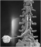 Verify the patient is doing OK Verify the neurostimulator is functional - other types of neurostimulators After MRI Reprogram the neurostimulator to pre-mri settings Spinal Cord Neurostimulator for