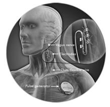 Vagus Nerve Stimulator Vagus Nerve Stimulator is used to treat epilepsy and depression. MR safety guidelines (for cybersonics products) Stimulator Off 1.5T/3T scanner T/R coil only SAR level of 3.