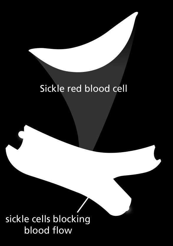 A point mutation in the Hb β gene is responsible for the sickling of RBCs seen in sickle