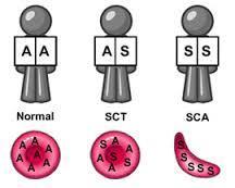 HbS can be inherited in the homozygous state (S/S) produce sickle cell anemia, or in heterozygous (A/S),also called sickle cell trait, usually don t exhibit symptoms of the sickle cell anemia disease