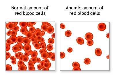 Anemia : It is in general decrease in the amount of RBC or the normal amount of Hb in blood.