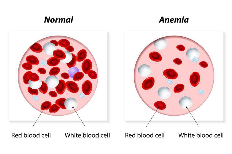 Red Blood Cells & Anemia Anemia is a decrease in the O 2 carrying
