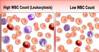 Conditions of Abnormal Number of Leukocytes Leukocytosis = High WBC count >11,000 cells/mm 3 Generally indicates an infection Leukemia =