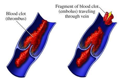 Undesirable Clotting Thrombus A clot in an unbroken blood vessel Can be deadly in areas such as the heart