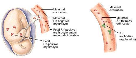 Fetal Rh+ and Maternal Rh- Maternal