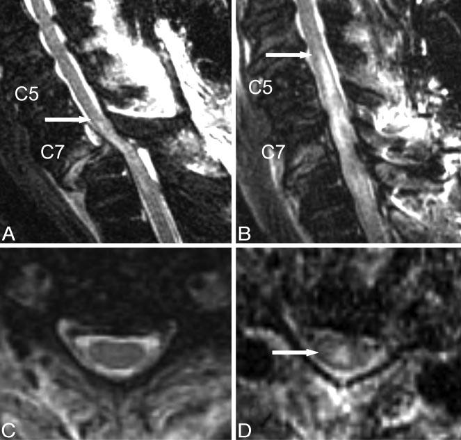 Fig 1. Short-interval follow-up cervical MR imaging of a 67-year-old male ASIA A patient with SCI. T2-weighted FSE images were obtained from an initial MR imaging examination performed 9.
