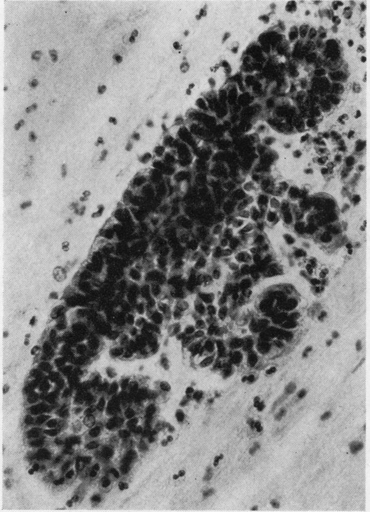 In the surrounding mucus are many eosinophil leucocytes with bilobed nuclei.
