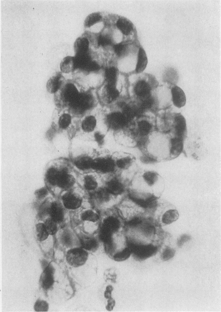 88 FIG. 16 FIG. 17 FIG. 16. Smear of sputum. A cluster of adenocarcincmatous cells. It is not too compact, has a knobby outline, and the nuclei appear malignant. Papanicolaou x 600. FIG. 17. A cluster of adenocarcinomatous cells a few of which are vacuolated.