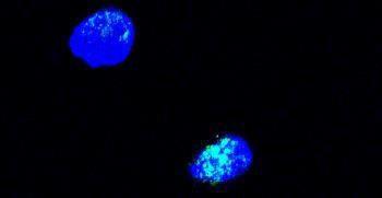 6 nuclear aggregates/cell CTRL83- F-52yr- w/o OA family history 28% of cells negative for PHB1 signal,