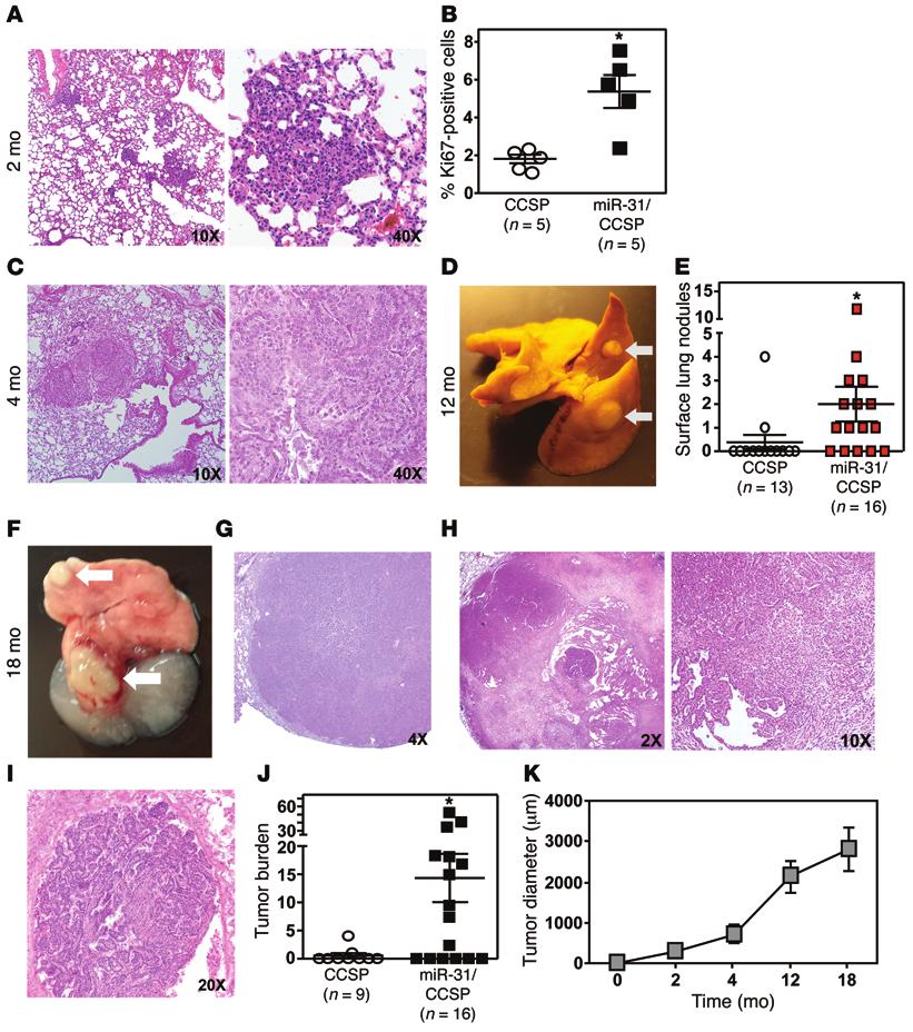The Journal of Clinical Investigation Research article Figure 4. mir-31 initiates benign and malignant lung tumor formation in vivo.