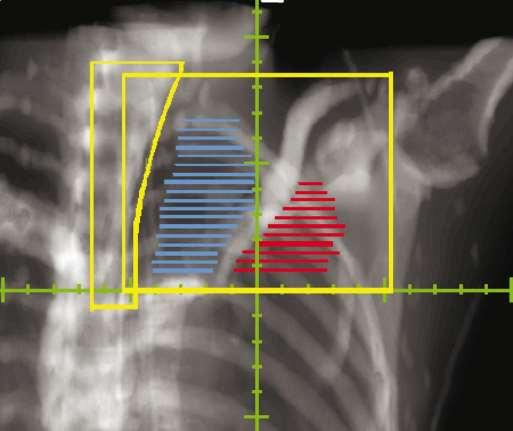 Supraclavicular and infraclavicular nodes Potential benefits: 1) Decreased shoulder