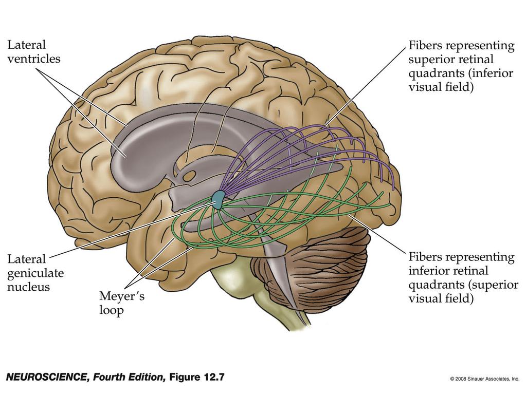 Figure 12.7 Course of the optic radiation to the striate cortex 