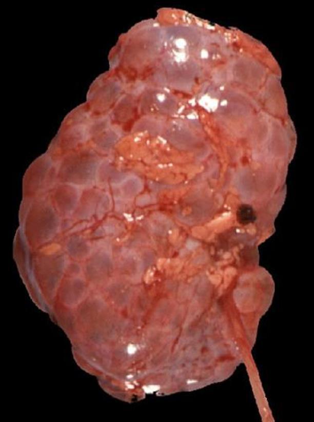 Autosomal Recessive Polycystic Kidney Disease (Childhood) (Childhood) Rare and distinct from ADPKD Defect