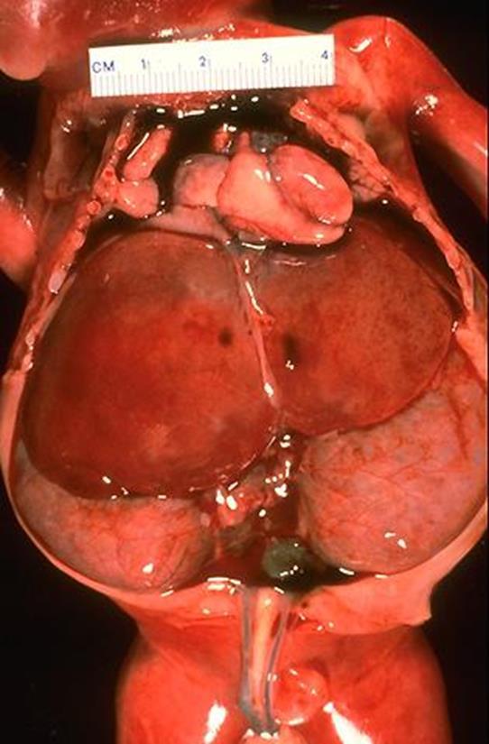 Autosomal Recessive Polycystic Kidney Disease Liver also has cysts Progressive hepatic