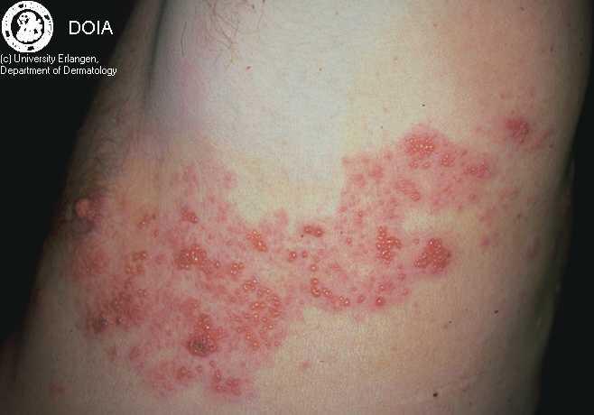 Shingles Varicella-zoster virus ( of the herpes family) In