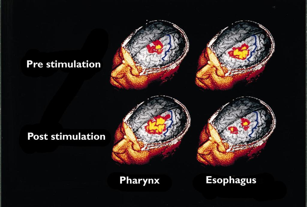 article Fig. 4 MRI co-registration of scalp maps.