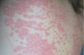 Rash Grading Mild rash Moderate rash Severe rash Localized skin