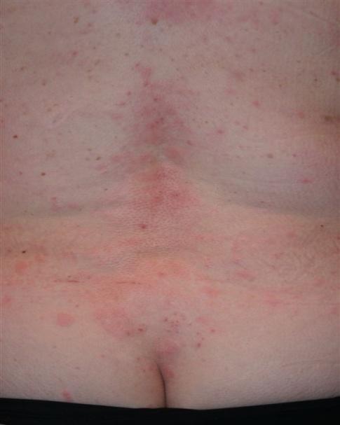 several isolated sites on the body) Diffuse rash involving 50% of