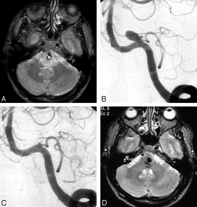 Fig 1. A 49-year-old man presenting with left abducens and right facial nerve palsies. A, MR imaging demonstrates an aneurysm compressing the medulla and pons with surrounding edema.