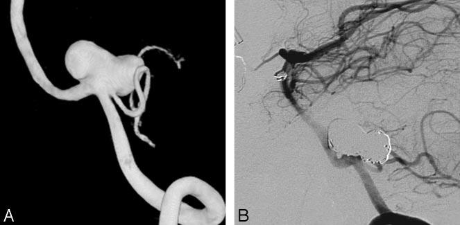 Fig 2. A 52-year-old woman with an incidentally found PICA aneurysm. A, 3D left vertebral angiogram demonstrates PICA aneurysm with the PICA originating from the sac.