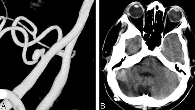 Fig 3. Ruptured PICA aneurysm in a 62-year-old man presenting in poor clinical condition. A, 3D right vertebral angiogram shows a wide-necked PICA aneurysm.