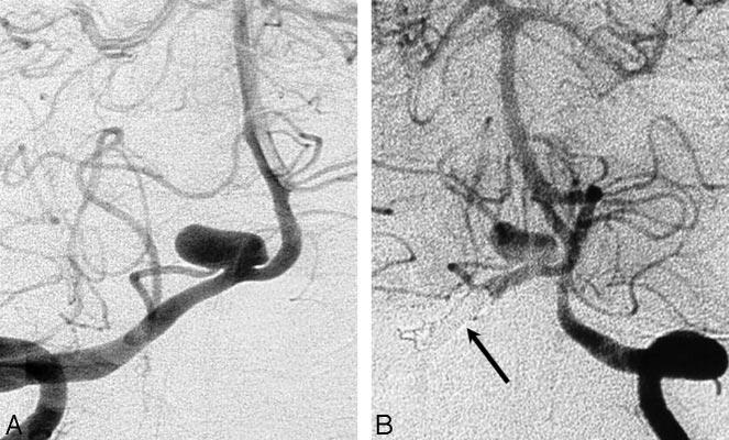 B, Angiography in the process of coiling, with occlusion of the PICA including the VA and PICA origin.