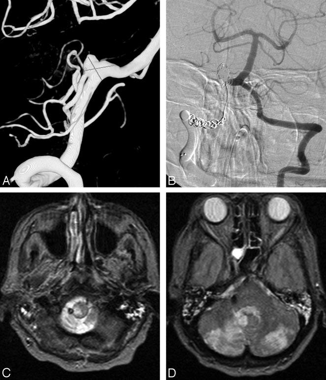 Fig 6. A 71-year-old woman presenting with acute SAH in poor clinical condition. A, 3D right vertebral angiogram shows broad-based PICA aneurysm with PICA originating from the sac.