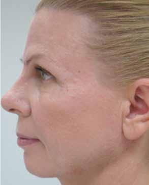 The author has seen clear improvements even with the most difficult icepick scars. It can also be used safely for patients who have undergone previous ablative laser resurfacing treatments.