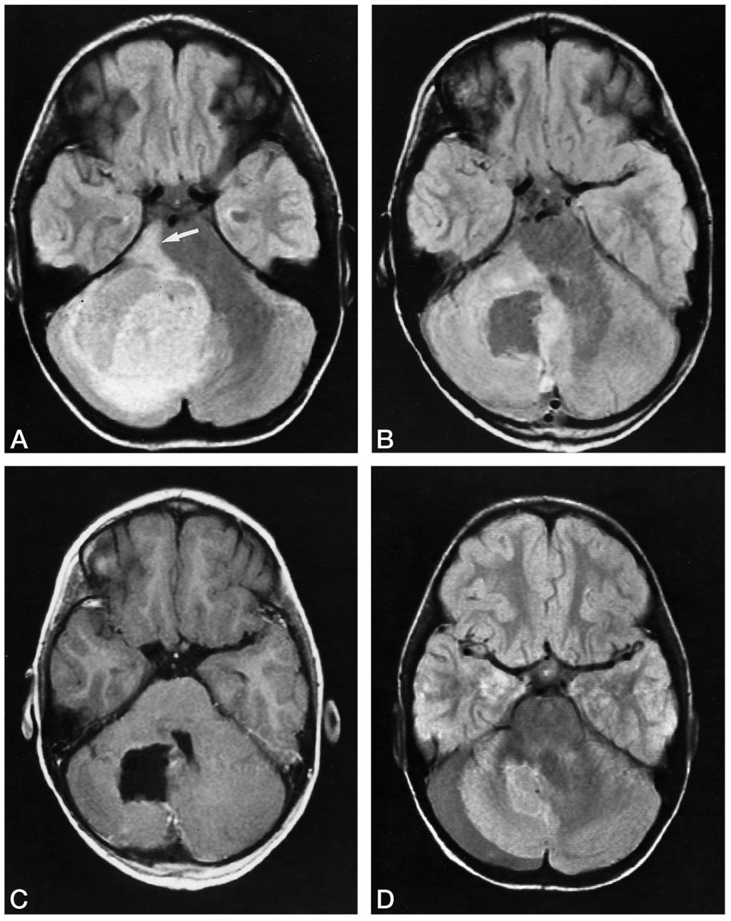 154 ROLLINS AJNR: 19, January 1998 FIG 2. A 4-year-old boy with right cerebellar JPA in whom abnormal T2 signal mimicked residual tumor on perioperative MR images.