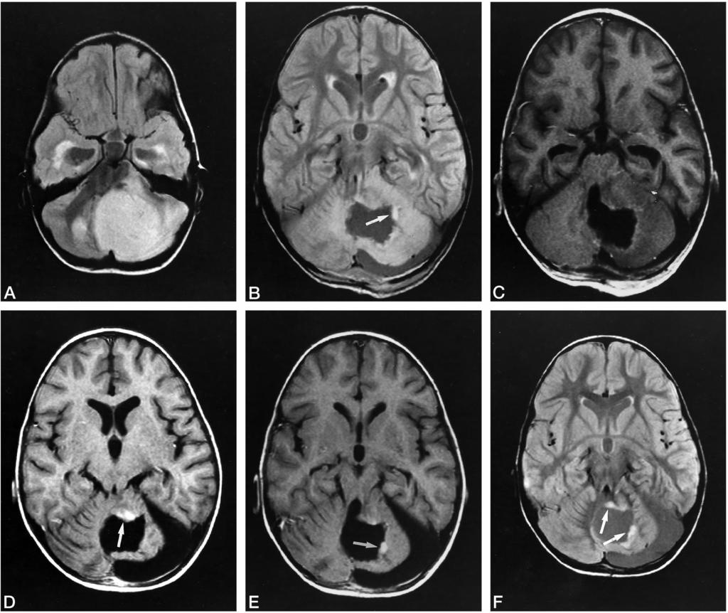 AJNR: 19, January 1998 JUVENILE ASTROCYTOMA 155 FIG 3. A 5-year-old girl with left cerebellar JPA.