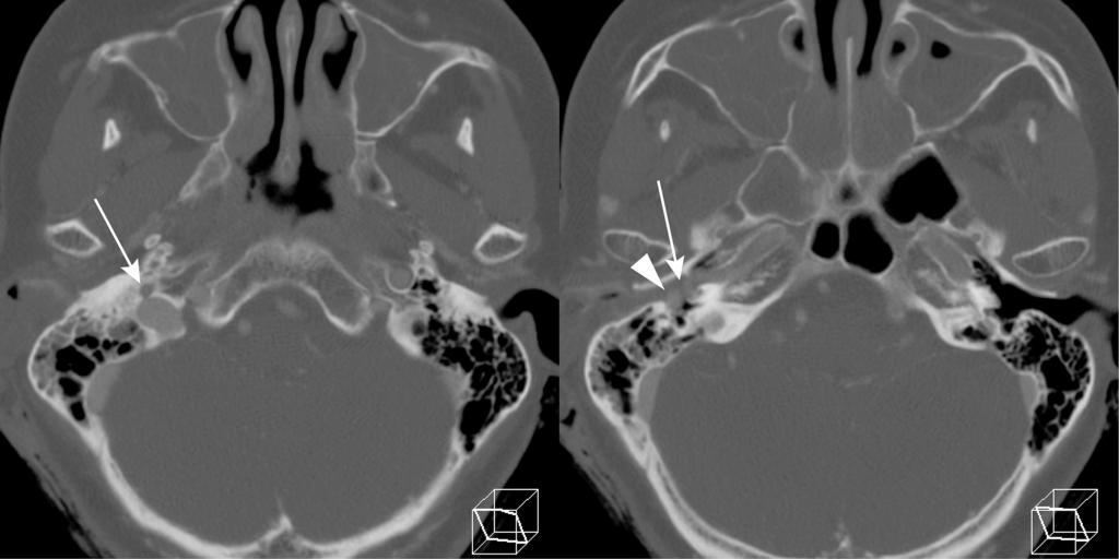 Hirono S, et al Fig. 1 CT scan on arrival. The aberrant internal carotid artery (IC, arrow) running through the enlarged inferior tympanic canaliculus (ITyC).