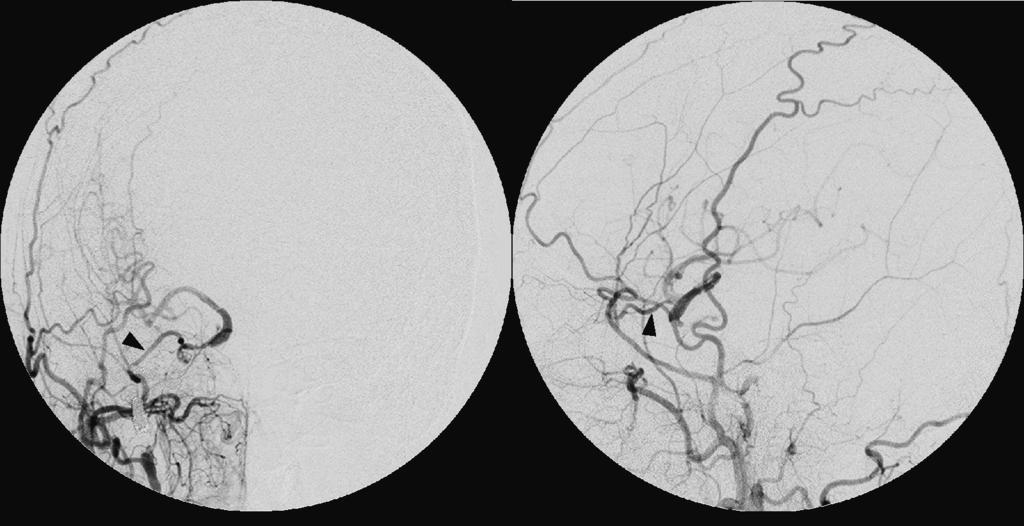 Hirono S, et al Fig. 3 Post-trapping right internal carotid angiogram, frontal view () and lateral view ().