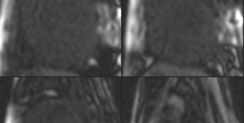 Contrast-Enhanced MRI of Myocardium First-Pass Perfusion Study