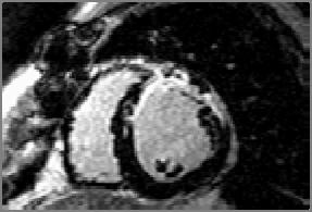 Contrast-enhanced MRI of the Heart T1-we eighted MR Signal In ntensity contrast injection Normal Myocardium < 1 min First-Pass Infarcted Myocardium ~10 min Delayed Enhancement time Delayed (Late)
