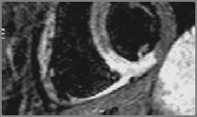Cardiac Phase-Resolved Edema Imaging in Acute MI