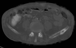CT: computed tomography; PET: positron emission tomography; ibl: image-based benign lesions; PPV: positive predictive value; NPV: negative predictive value. indeterminate lesions.