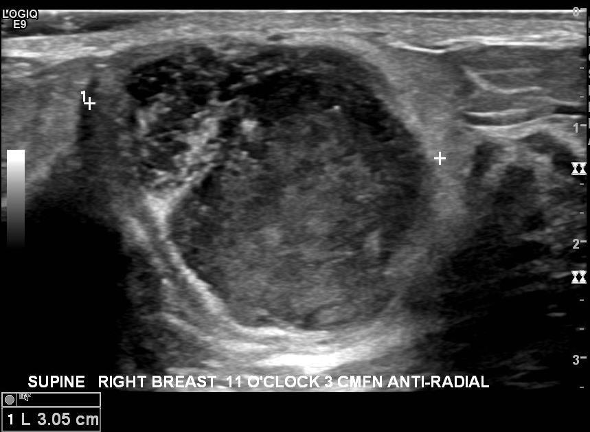 Differential diagnosis 1. Breast Abscess 2.