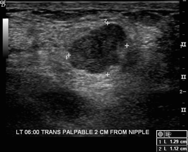 Adenomyoepithelioma Ultrasound reveals a
